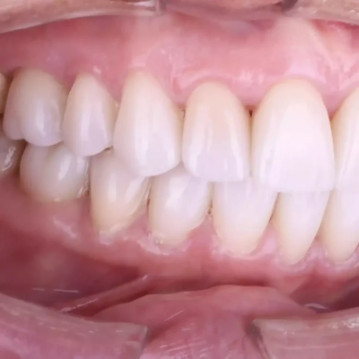 Veneers (4)