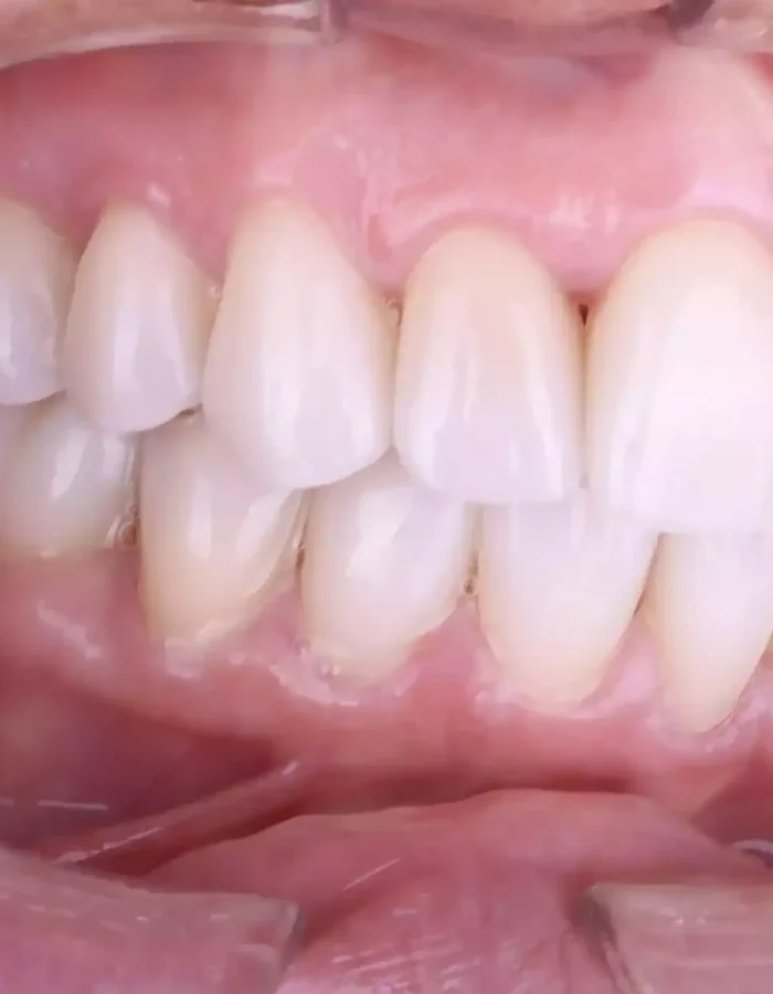 Veneers (4)