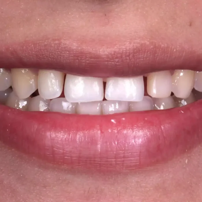 Veneers (5)