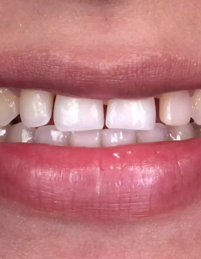 Veneers (5)