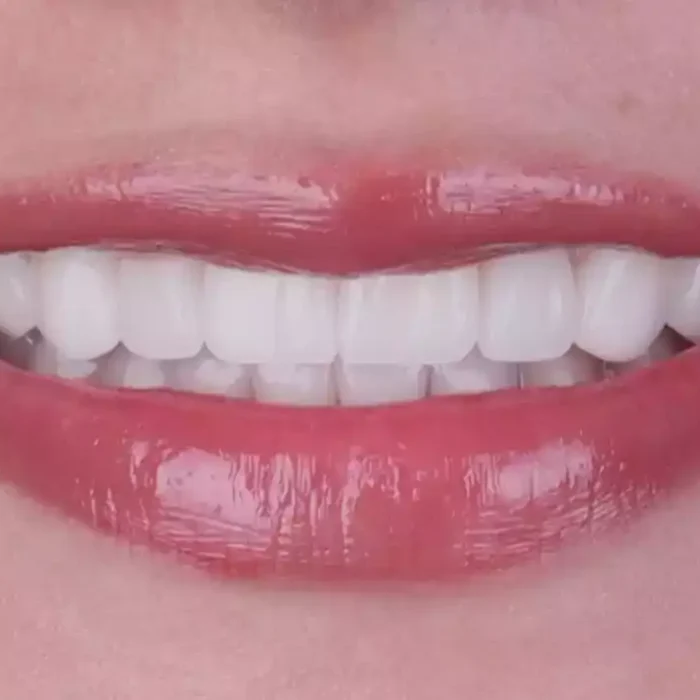 Veneers (6)