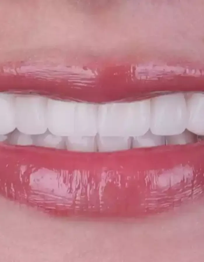 Veneers (6)