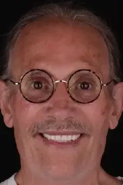 Trusted Molar Dentist in NYC for Pain-Free Care.