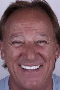 Close-up of a smiling mature man showing healthy teeth.